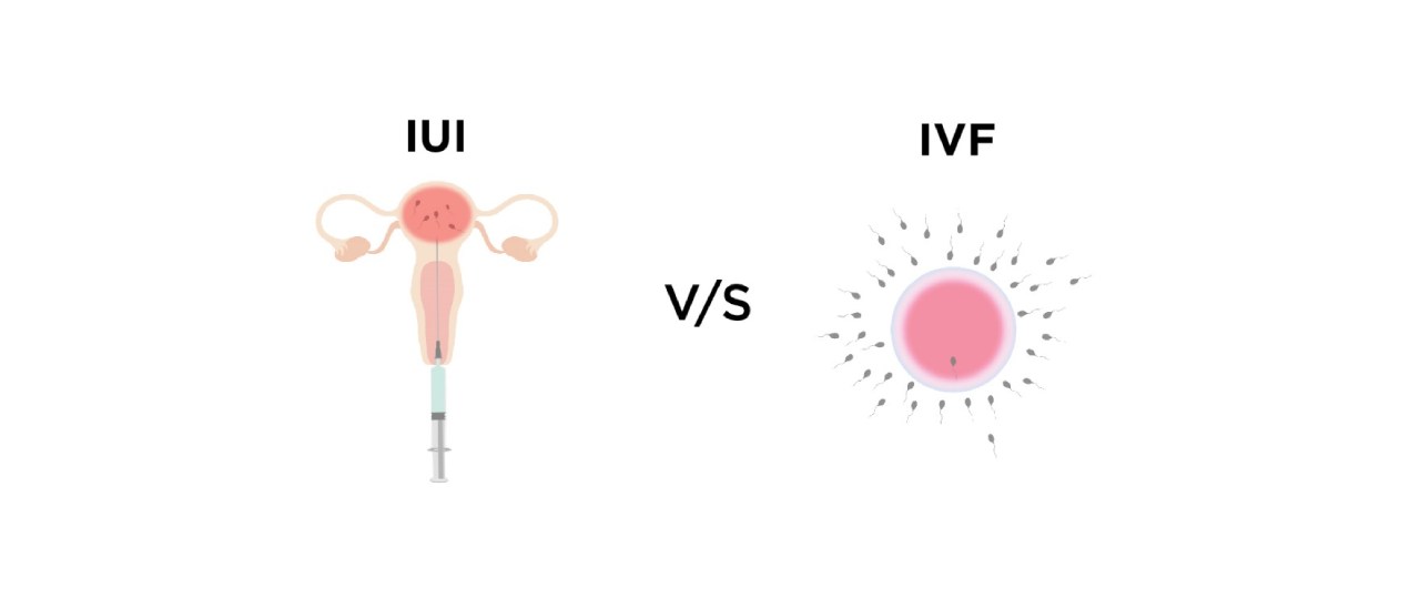 Iui And Ivf What Is The Difference Motherhood Ivf And Fertility Center